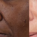 What skincare shrinks pores?