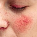 The Best Skincare Products for Men with Rosacea and Other Skin Conditions