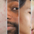 What are the 5 skin types?
