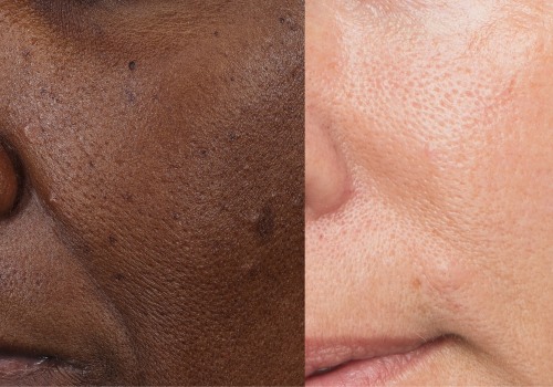 What skincare shrinks pores?