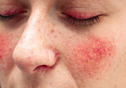The Best Skincare Products for Men with Rosacea and Other Skin Conditions