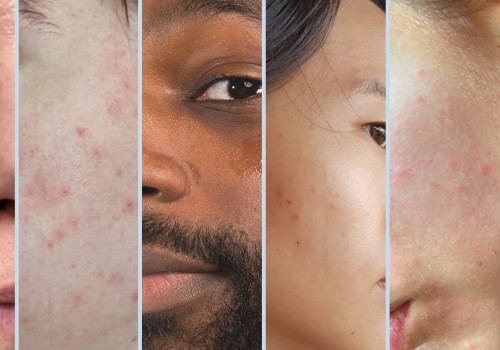 What are the 5 skin types?